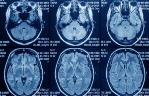 Disparidad en el acceso a tratamiento para glioblastoma pone en riesgo a pacientes, denuncia Astuce