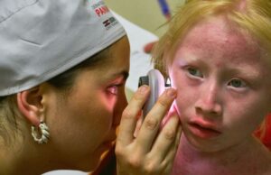 Campaña de Isdin en Panamá atiende a personas con albinismo para prevenir el cáncer de piel