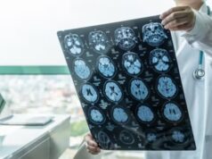 ASTUCE Spain impulsa el reconocimiento del oligodendroglioma como patología rara