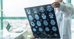 ASTUCE Spain impulsa el reconocimiento del oligodendroglioma como patología rara