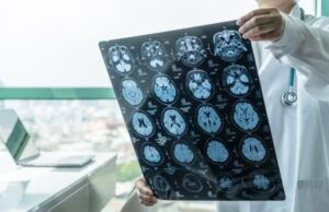 ASTUCE Spain impulsa el reconocimiento del oligodendroglioma como patología rara